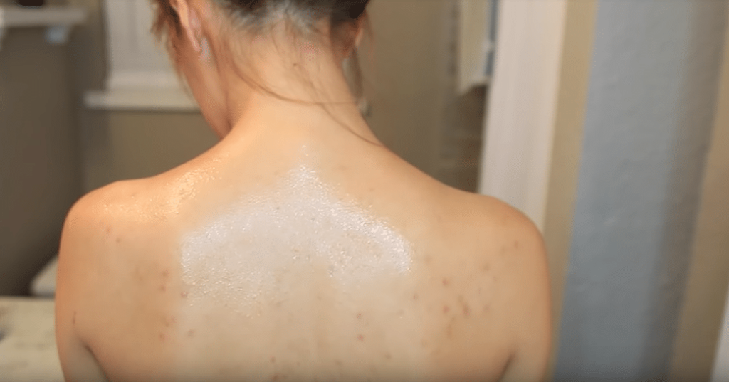 Buttons on the back natural remedy and advice to quickly eradicate them