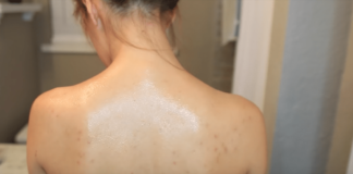 Buttons on the back natural remedy and advice to quickly eradicate them